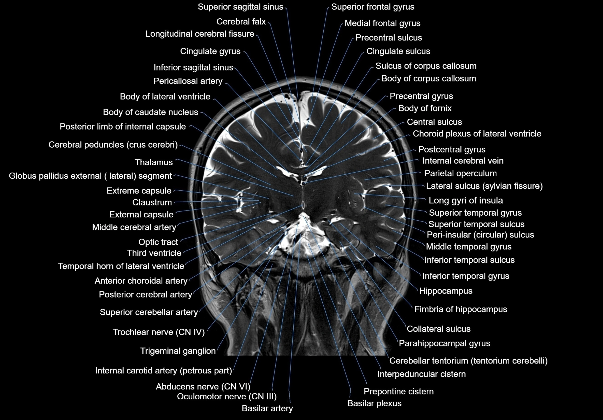 MRI Brain coronal cross sectional labelled anatomy 3T image  -img-00001-00038.webp
